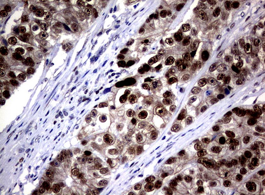 JUN / c-Jun Antibody - Immunohistochemical staining of paraffin-embedded Adenocarcinoma of Human colon tissue using anti-JUN mouse monoclonal antibody.  heat-induced epitope retrieval by 10mM citric buffer, pH6.0, 120C for 3min)