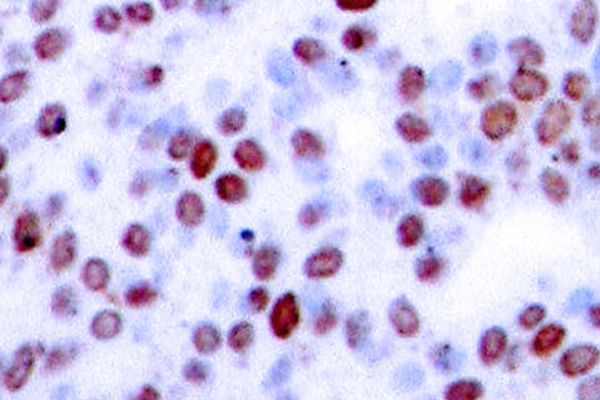 JUN / c-Jun Antibody - IHC of c-Jun (G237) pAb in paraffin-embedded human breast carcinoma tissue.