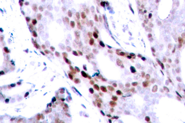 JUN / c-Jun Antibody - IHC of c-Jun (G67) pAb in paraffin-embedded human breast carcinoma tissue.