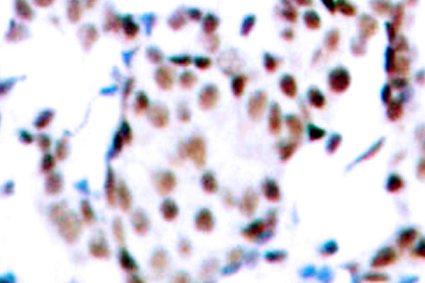 JUN / c-Jun Antibody - IHC of AP1 (H164) pAb in paraffin-embedded human breast carcinoma tissue.