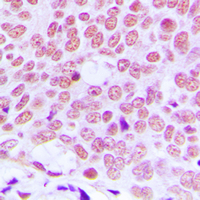JUN / c-Jun Antibody - Immunohistochemical analysis of c-Jun staining in human breast cancer formalin fixed paraffin embedded tissue section. The section was pre-treated using heat mediated antigen retrieval with sodium citrate buffer (pH 6.0). The section was then incubated with the antibody at room temperature and detected using an HRP conjugated compact polymer system. DAB was used as the chromogen. The section was then counterstained with hematoxylin and mounted with DPX.