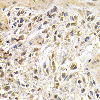 JUN / c-Jun Antibody - Immunohistochemistry of paraffin-embedded human stomach cancer tissue.