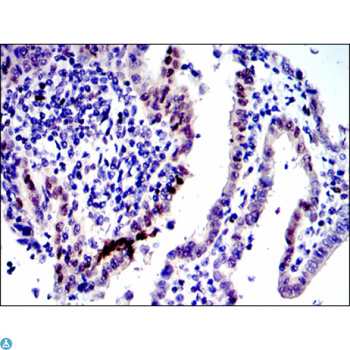 JUN / c-Jun Antibody - Immunohistochemistry (IHC) analysis of paraffin-embedded human intima canncer tissues with DAB staining using AP-1 Monoclonal Antibody.