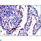 JUN / c-Jun Antibody - Immunohistochemistry (IHC) analysis of paraffin-embedded human intima canncer tissues with DAB staining using AP-1 Monoclonal Antibody.