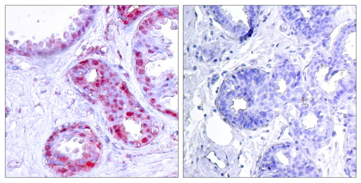 JUN / c-Jun Antibody - Immunohistochemistry analysis of paraffin-embedded human breast carcinoma, using c-Jun (Phospho-Ser243) Antibody. The picture on the right is blocked with the phospho peptide.