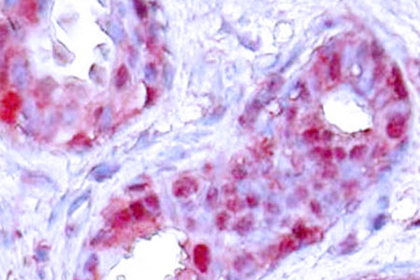JUN / c-Jun Antibody - IHC of p-c-Jun (S243) pAb in paraffin-embedded human breast carcinoma tissue.