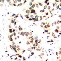 JUN / c-Jun Antibody - Immunohistochemical analysis of c-Jun (pS243) staining in human breast cancer formalin fixed paraffin embedded tissue section. The section was pre-treated using heat mediated antigen retrieval with sodium citrate buffer (pH 6.0). The section was then incubated with the antibody at room temperature and detected using an HRP conjugated compact polymer system. DAB was used as the chromogen. The section was then counterstained with hematoxylin and mounted with DPX.