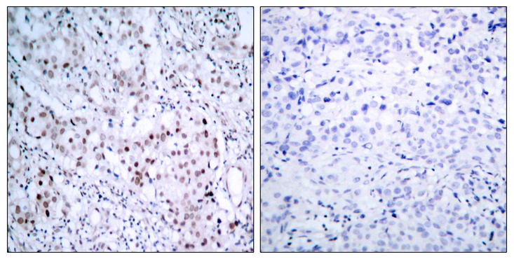 JUN / c-Jun Antibody - Immunohistochemistry analysis of paraffin-embedded human breast carcinoma, using c-Jun (Phospho-Ser63) Antibody. The picture on the right is blocked with the phospho peptide.
