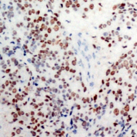 JUN / c-Jun Antibody - Immunohistochemical analysis of c-Jun (pS63) staining in human breast cancer formalin fixed paraffin embedded tissue section. The section was pre-treated using heat mediated antigen retrieval with sodium citrate buffer (pH 6.0). The section was then incubated with the antibody at room temperature and detected using an HRP conjugated compact polymer system. DAB was used as the chromogen. The section was then counterstained with hematoxylin and mounted with DPX.
