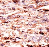 JUN / c-Jun Antibody - Formalin-fixed and paraffin-embedded human cancer tissue reacted with the primary antibody, which was peroxidase-conjugated to the secondary antibody, followed by AEC staining. This data demonstrates the use of this antibody for immunohistochemistry; clinical relevance has not been evaluated. BC = breast carcinoma; HC = hepatocarcinoma.