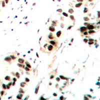 JUN / c-Jun Antibody - Immunohistochemical analysis of c-Jun (pS73/100) staining in human breast cancer formalin fixed paraffin embedded tissue section. The section was pre-treated using heat mediated antigen retrieval with sodium citrate buffer (pH 6.0). The section was then incubated with the antibody at room temperature and detected using an HRP conjugated compact polymer system. DAB was used as the chromogen. The section was then counterstained with hematoxylin and mounted with DPX.