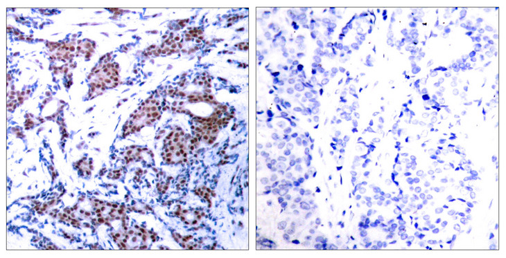 JUN / c-Jun Antibody - Immunohistochemistry analysis of paraffin-embedded human breast carcinoma, using c-Jun (Phospho-Ser73) Antibody. The picture on the right is blocked with the phospho peptide.