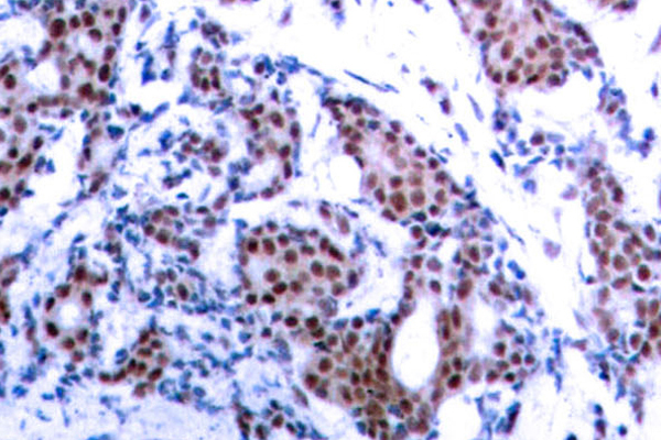 JUN / c-Jun Antibody - IHC of p-c-Jun (S73) pAb in paraffin-embedded human breast carcinoma tissue.