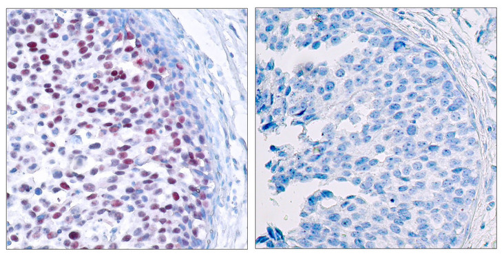 JUN / c-Jun Antibody - Immunohistochemistry analysis of paraffin-embedded human breast carcinoma, using c-Jun (Phospho-Thr239) Antibody. The picture on the right is blocked with the phospho peptide.