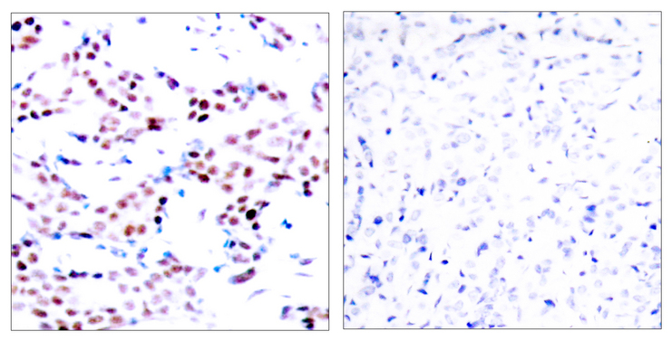 JUN / c-Jun Antibody - Immunohistochemistry analysis of paraffin-embedded human breast carcinoma, using c-Jun (Phospho-Thr91) Antibody. The picture on the right is blocked with the phospho peptide.