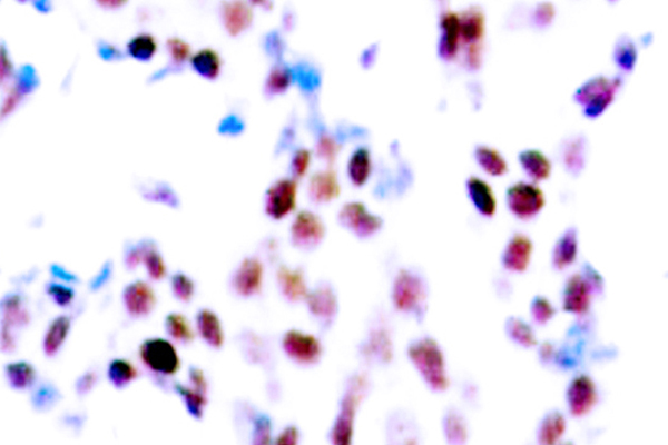 JUN / c-Jun Antibody - IHC of p-c-Jun (T91) pAb in paraffin-embedded human breast carcinoma tissue.
