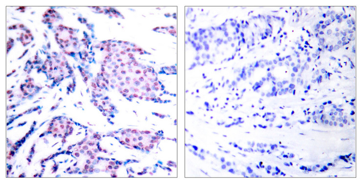 JUN / c-Jun Antibody - Immunohistochemistry analysis of paraffin-embedded human breast carcinoma, using c-Jun (Phospho-Thr93) Antibody. The picture on the right is blocked with the phospho peptide.