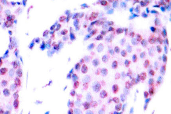 JUN / c-Jun Antibody - IHC of p-c-Jun (T93)pAb in paraffin-embedded human breast carcinoma tissue.