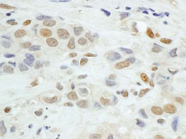JUNB / JUN-B Antibody - Detection of Human JunB by Immunohistochemistry. Sample: FFPE section of human breast carcinoma. Antibody: Affinity purified rabbit anti-JunB used at a dilution of 1:1000 (0.2 ug/ml). Detection: DAB.