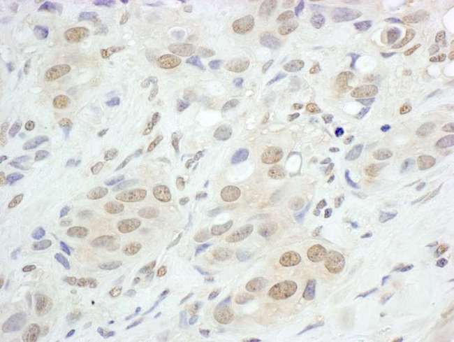 JUNB / JUN-B Antibody - Detection of Human JunB by Immunohistochemistry. Sample: FFPE section of human breast carcinoma. Antibody: Affinity purified rabbit anti-JunB used at a dilution of 1:5000 (0.2 ug/ml). Detection: DAB.