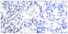 JUNB / JUN-B Antibody - Immunohistochemistry analysis of paraffin-embedded human breast carcinoma tissue, using JunB Antibody. The picture on the right is blocked with the synthesized peptide.