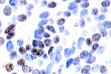JUNB / JUN-B Antibody - IHC of JunB (D253) pAb in paraffin-embedded human breast carcinoma tissue.