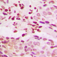 JUNB / JUN-B Antibody - Immunohistochemical analysis of JUNB (pS259) staining in human breast cancer formalin fixed paraffin embedded tissue section. The section was pre-treated using heat mediated antigen retrieval with sodium citrate buffer (pH 6.0). The section was then incubated with the antibody at room temperature and detected using an HRP conjugated compact polymer system. DAB was used as the chromogen. The section was then counterstained with hematoxylin and mounted with DPX.