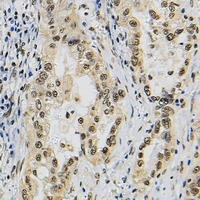 JUNB / JUN-B Antibody - Immunohistochemical analysis of JUNB staining in human lung cancer formalin fixed paraffin embedded tissue section. The section was pre-treated using heat mediated antigen retrieval with sodium citrate buffer (pH 6.0). The section was then incubated with the antibody at room temperature and detected with HRP and DAB as chromogen. The section was then counterstained with hematoxylin and mounted with DPX.