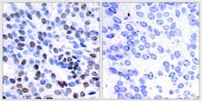 JUNB / JUN-B Antibody - Peptide - + Immunohistochemical analysis of paraffin-embedded human breast carcinoma tissue using JunB (Ab-259) antibody.