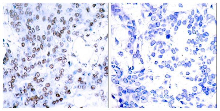 JUNB / JUN-B Antibody - Immunohistochemical analysis of paraffin-embedded breast carcinoma. Left: Using JunB (Ab-79) Antibody; Right: The same antibody preincubated with synthesized peptide.