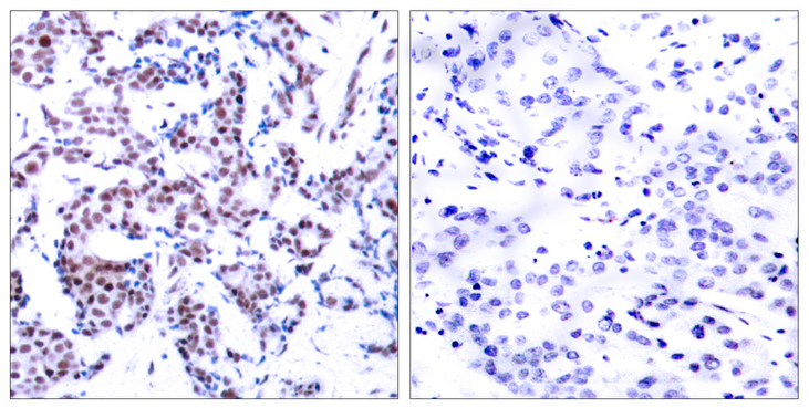 JUNB / JUN-B Antibody - Immunohistochemistry analysis of paraffin-embedded human breast carcinoma, using JunB (Phospho-Ser259) Antibody. The picture on the right is blocked with the phospho peptide.