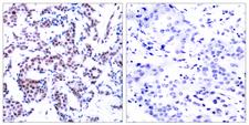 JUNB / JUN-B Antibody - Immunohistochemistry analysis of paraffin-embedded human breast carcinoma, using JunB (Phospho-Ser259) Antibody. The picture on the right is blocked with the phospho peptide.