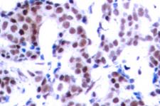 JUNB / JUN-B Antibody - IHC of p-JunB (S259) pAb in paraffin-embedded human breast carcinoma tissue.
