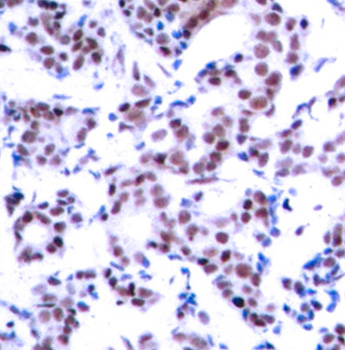 JUNB / JUN-B Antibody - Immunohistochemical analysis of paraffin-embedded human breast carcinoma tissue.