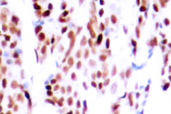 JUNB / JUN-B Antibody - IHC of p-JunB (S79) pAb in paraffin-embedded human breast carcinoma tissue.