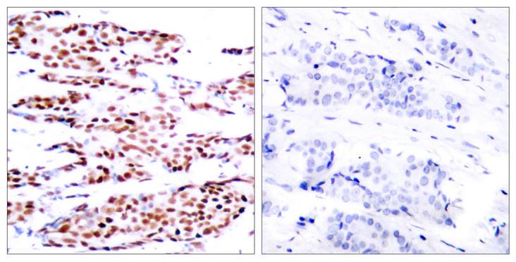 JUNB / JUN-B Antibody - Immunohistochemical analysis of paraffin-embedded breast carcinoma. Left: Using JunB(Phospho-Ser79) Antibody; Right: The same antibody preincubated with synthesized phosphopeptide.