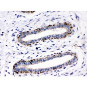 Junctin / ASPH Antibody - ASPH antibody IHC-paraffin. IHC(P): Human Mammary Cancer Tissue.