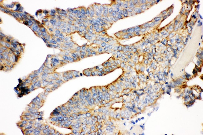 JUP/CTNNG/Junction Plakoglobin Antibody - gamma Catenin antibody IHC-paraffin: Human Intestinal Cancer Tissue.
