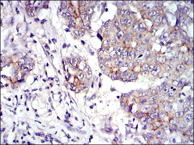 JUP/CTNNG/Junction Plakoglobin Antibody - IHC of paraffin-embedded stomach cancer tissues using JUP mouse monoclonal antibody with DAB staining.