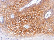 JUP/CTNNG/Junction Plakoglobin Antibody - IHC testing of FFPE human cervical carcinoma with Plakoglobin antibody (clone CTNG/1483). Required HIER: boil tissue sections in 10mM Tris with 1mM EDTA, pH 9, for 10-20 min.