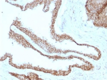 JUP/CTNNG/Junction Plakoglobin Antibody - IHC testing of FFPE human prostate carcinoma with Gamma Catenin antibody (clone CTNG/1483). Required HIER: boil tissue sections in 10mM Tris with 1mM EDTA, pH 9, for 10-20 min.