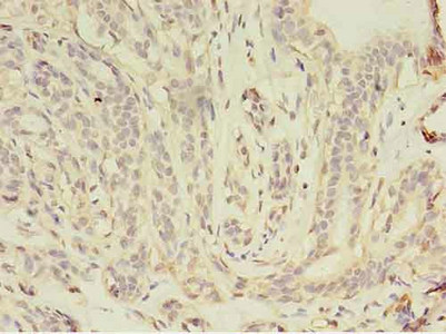 JUP/CTNNG/Junction Plakoglobin Antibody - Immunohistochemistry of paraffin-embedded human breast cancer using JUP Antibody at dilution of 1:100
