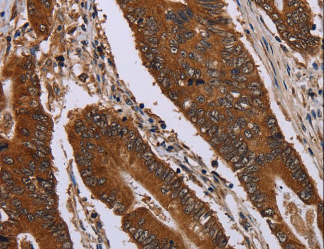 JUP/CTNNG/Junction Plakoglobin Antibody - Immunohistochemistry of paraffin-embedded Human colon cancer using JUP Polyclonal Antibody at dilution of 1:40.