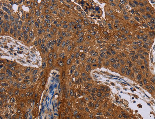 JUP/CTNNG/Junction Plakoglobin Antibody - Immunohistochemistry of paraffin-embedded Human lung cancer using JUP Polyclonal Antibody at dilution of 1:40.