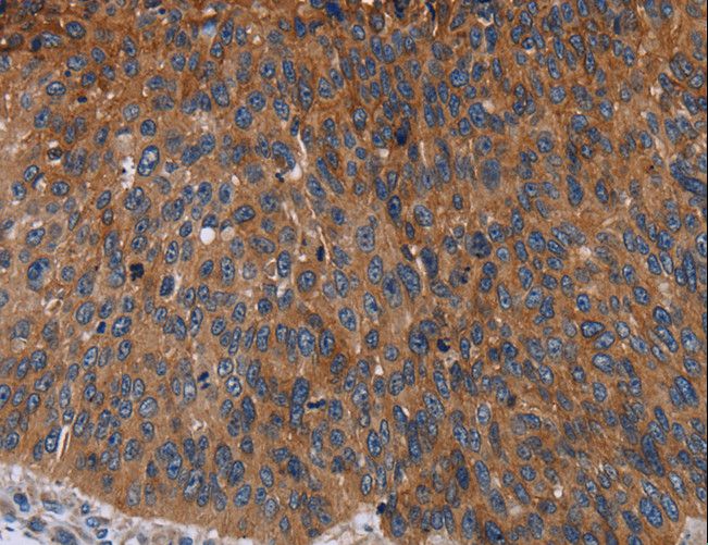 JUP/CTNNG/Junction Plakoglobin Antibody - Immunohistochemistry of paraffin-embedded Human lung cancer using JUP Polyclonal Antibody at dilution of 1:50.