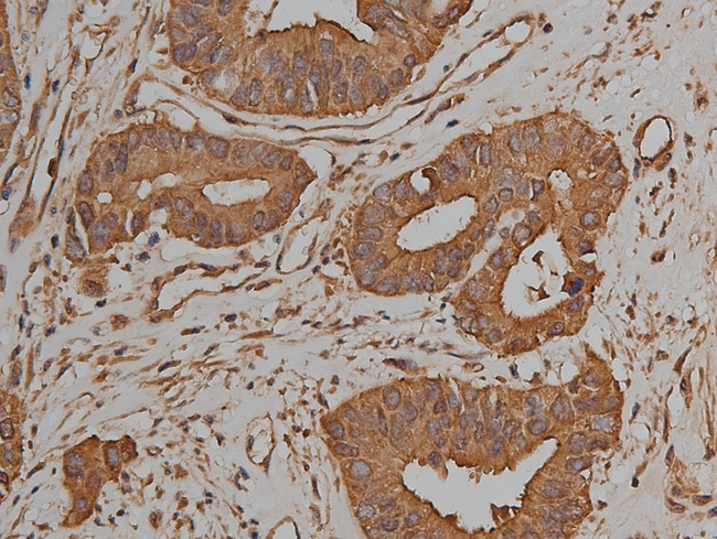 JUP/CTNNG/Junction Plakoglobin Antibody - 1:50 staining human colon carcinoma tissue by IHC-P. The tissue was formaldehyde fixed and a heat mediated antigen retrieval step in citrate buffer was performed. The tissue was then blocked and incubated with the antibody for 1.5 hours at 22°C. An HRP conjugated goat anti-rabbit antibody was used as the secondary.