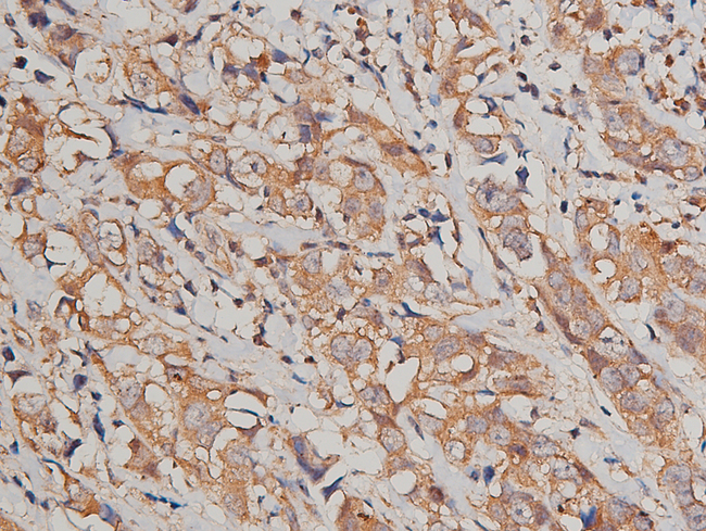 JUP/CTNNG/Junction Plakoglobin Antibody - 1:200 staining human breast carcinoma tissue by IHC-P. The tissue was formaldehyde fixed and a heat mediated antigen retrieval step in citrate buffer was performed. The tissue was then blocked and incubated with the antibody for 1.5 hours at 22°C. An HRP conjugated goat anti-rabbit antibody was used as the secondary.