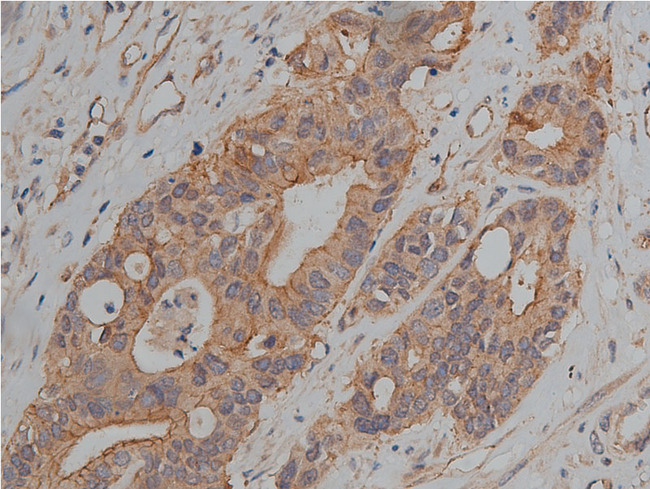 JUP/CTNNG/Junction Plakoglobin Antibody - 1:200 staining human colon carcinoma tissue by IHC-P. The tissue was formaldehyde fixed and a heat mediated antigen retrieval step in citrate buffer was performed. The tissue was then blocked and incubated with the antibody for 1.5 hours at 22°C. An HRP conjugated goat anti-rabbit antibody was used as the secondary.