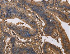 K13 / KCNG Antibody - Immunohistochemistry of paraffin-embedded Human liver cancer using KCNG1 Polyclonal Antibody at dilution of 1:40.