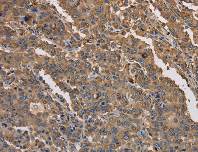 K13 / KCNG Antibody - Immunohistochemistry of paraffin-embedded Human liver cancer using KCNG1 Polyclonal Antibody at dilution of 1:40.